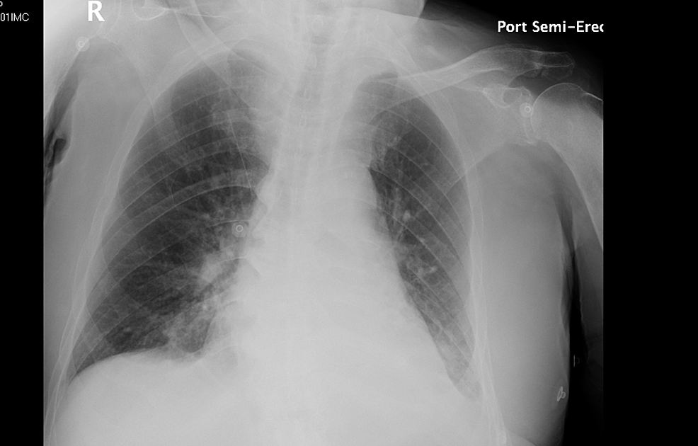 Case-3-chest-X-ray-on-admission-on-April-12,-2020