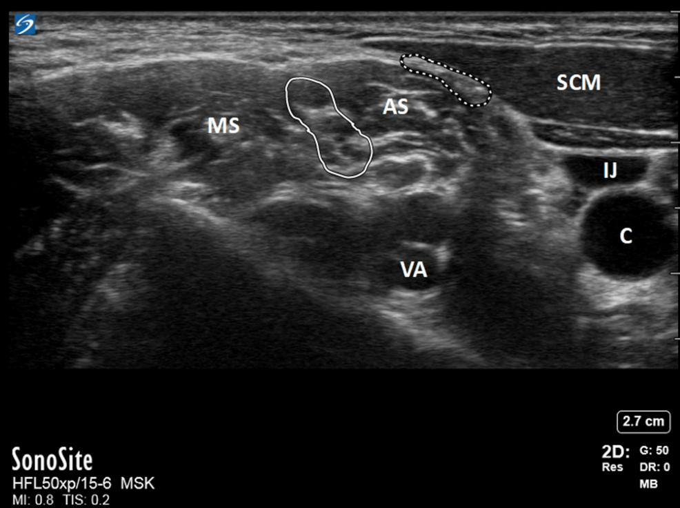 Ultrasound-Image-Showing-the-Brachial-Plexus-and-Surrounding-Anatomy-at-the-ISG