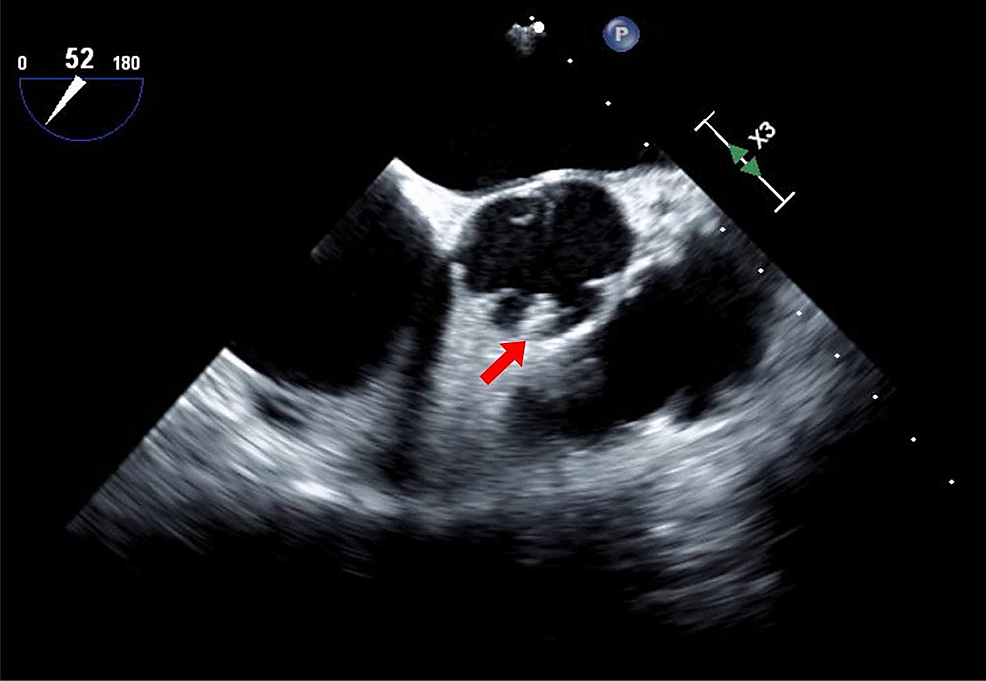 Cureus | What’s That in the Aorta? A Case of Asymptomatic Dislodged ...