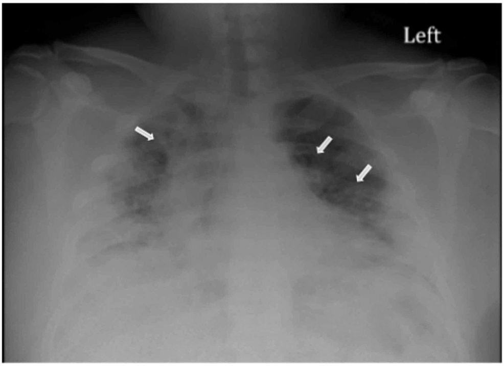 Cureus | Bilateral Pulmonary Embolism in a Discharged Patient With ...