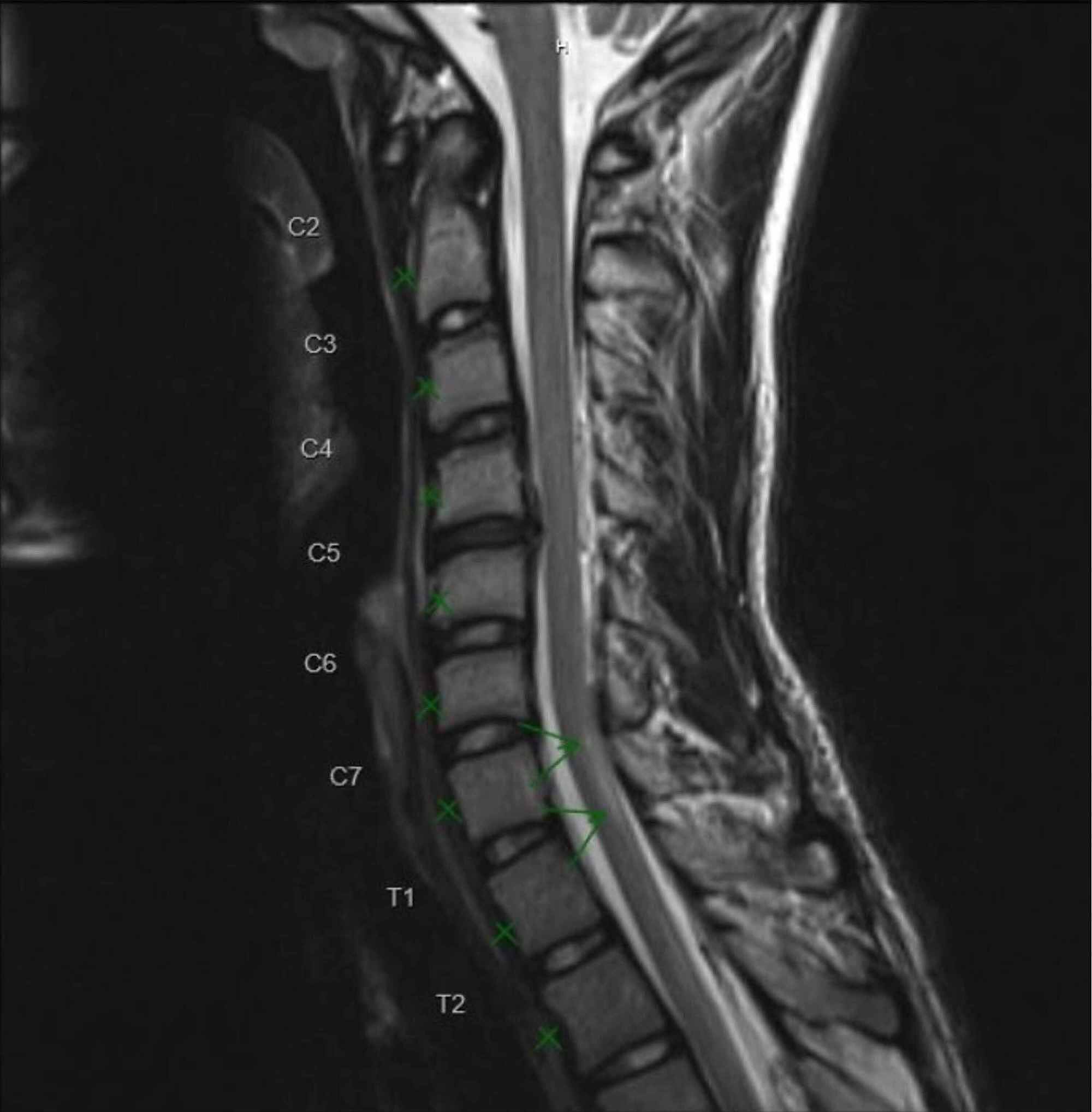 Cureus Synchronous Occurrence Of Guillain Barre Syndrome And Transverse Myelitis Of Unknown Etiology In An Adolescent