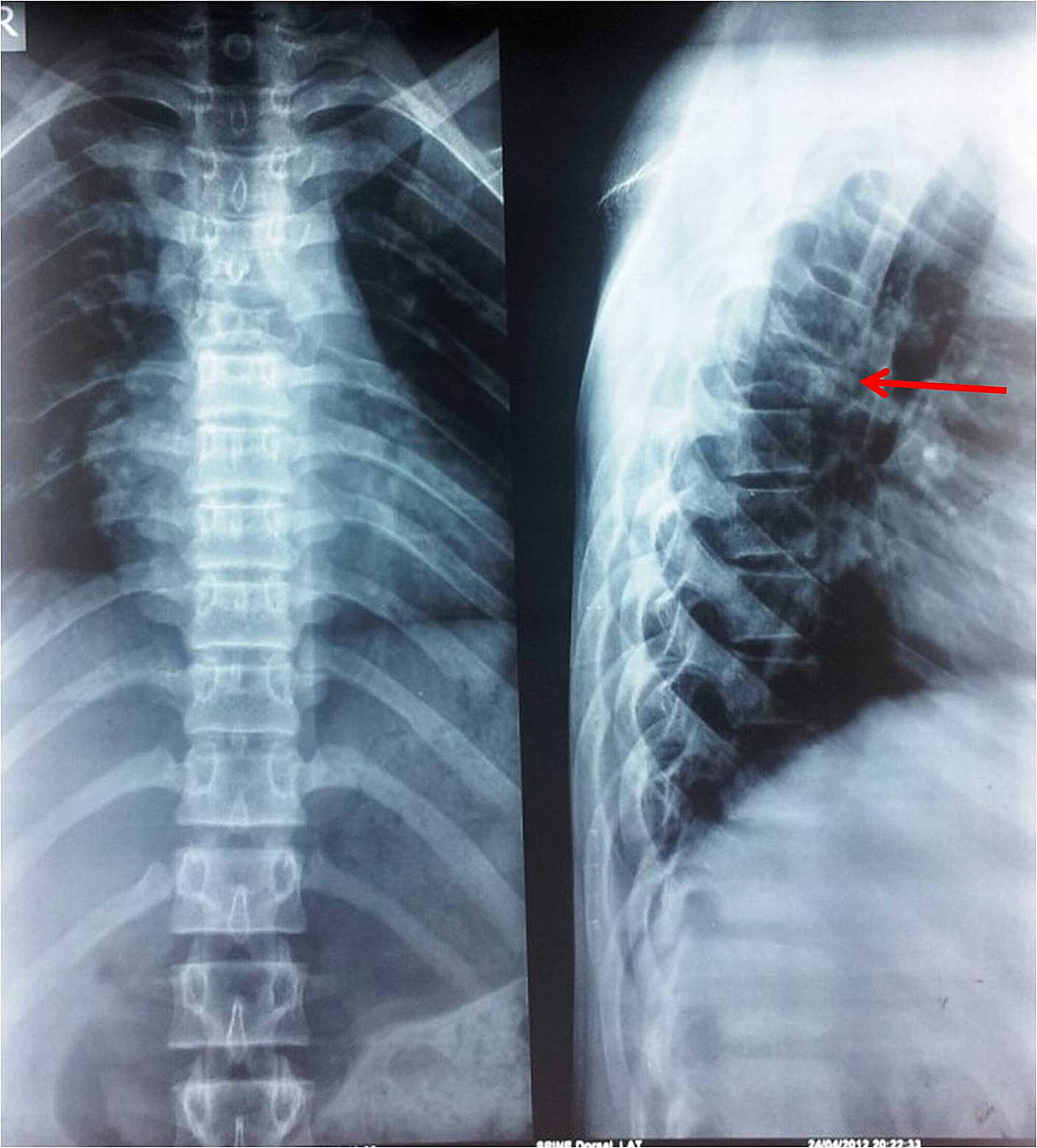 Cureus | Solid Variant of an Aneurysmal Bone Cyst of the Thoracic Spine