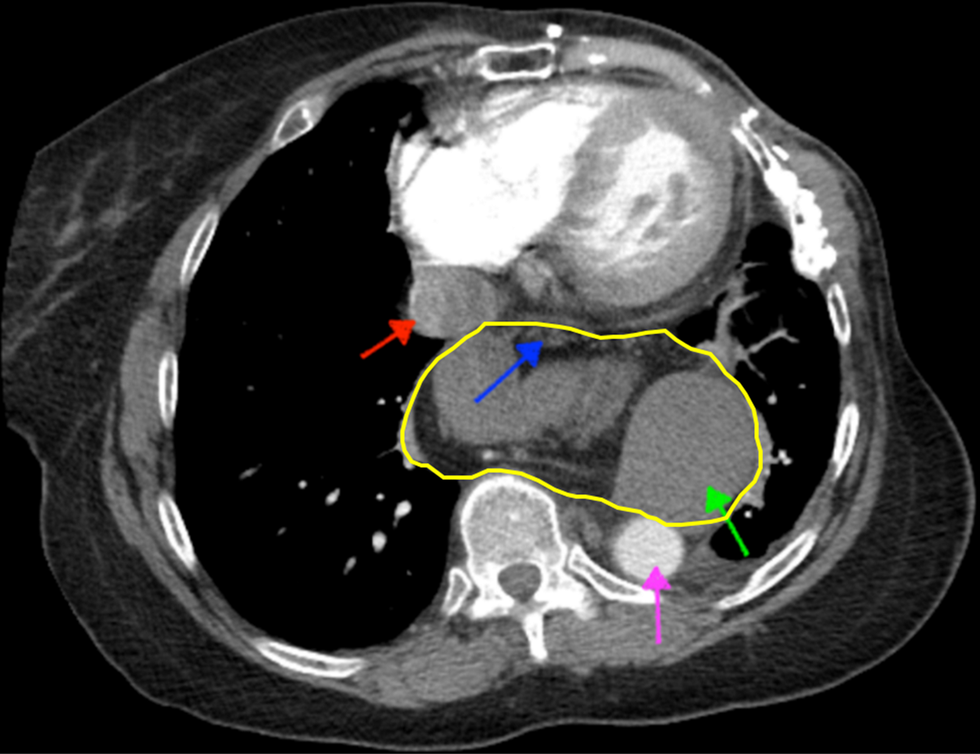Hiatal Hernia On Ct Scan | Images and Photos finder