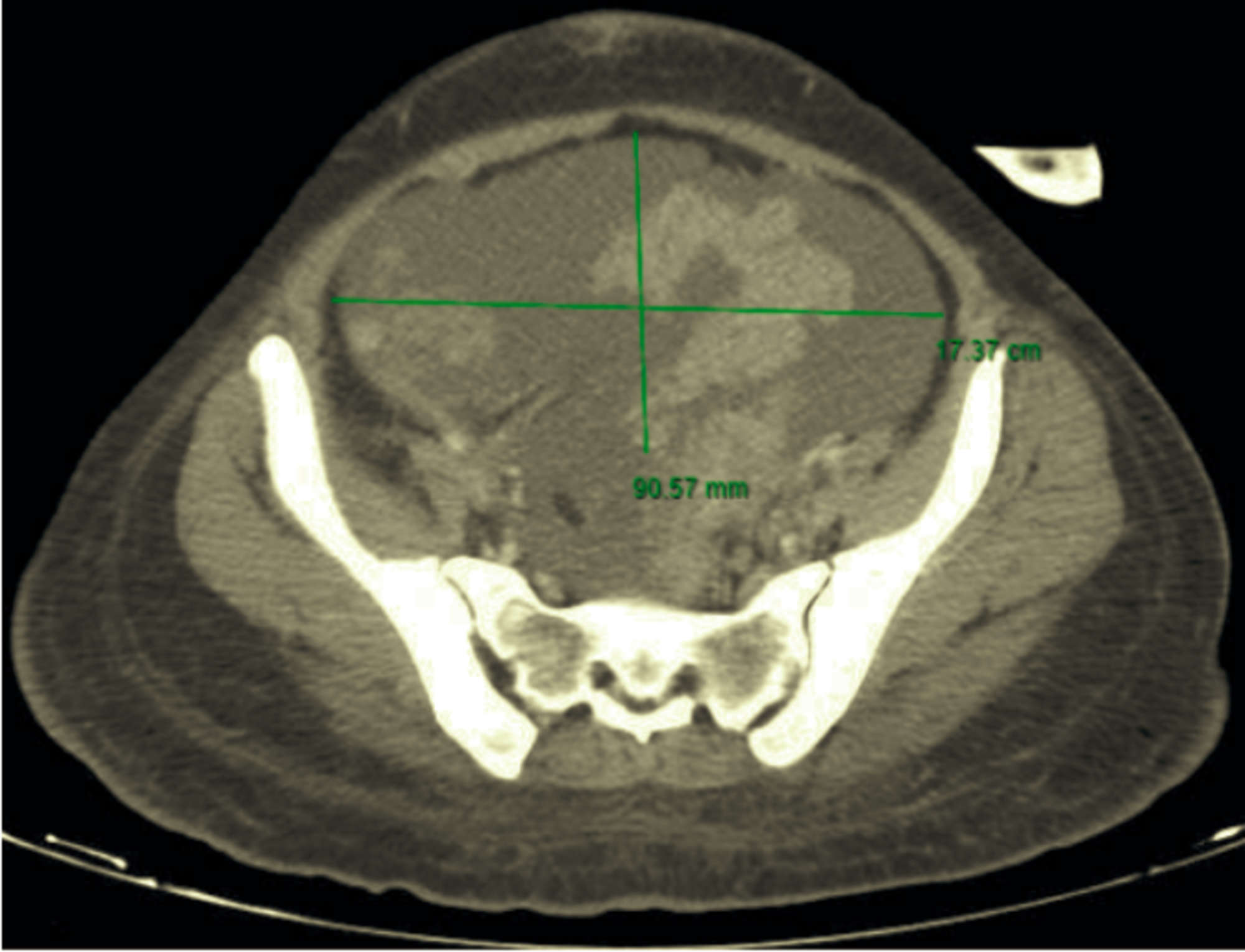 Cureus Unclassified Mixed Germ Cell Sex Cord Stromal Tumor Of The Ovary An Unusual Case Report 4060