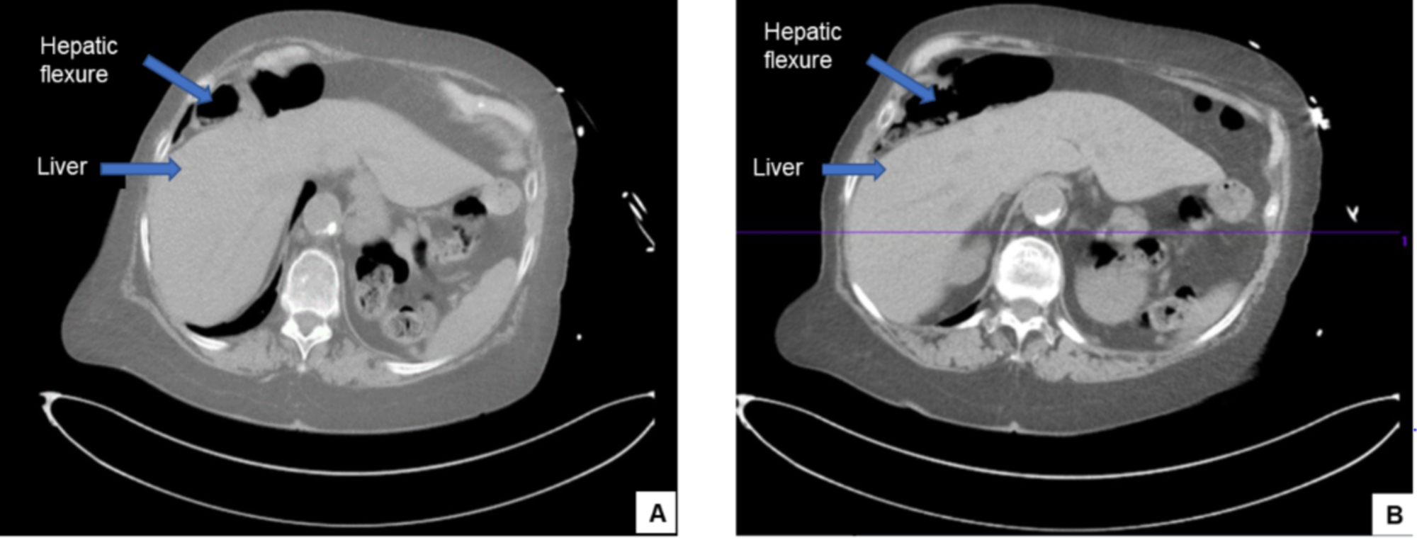 hepatic flexture syndrome hepatic flexture syndrome