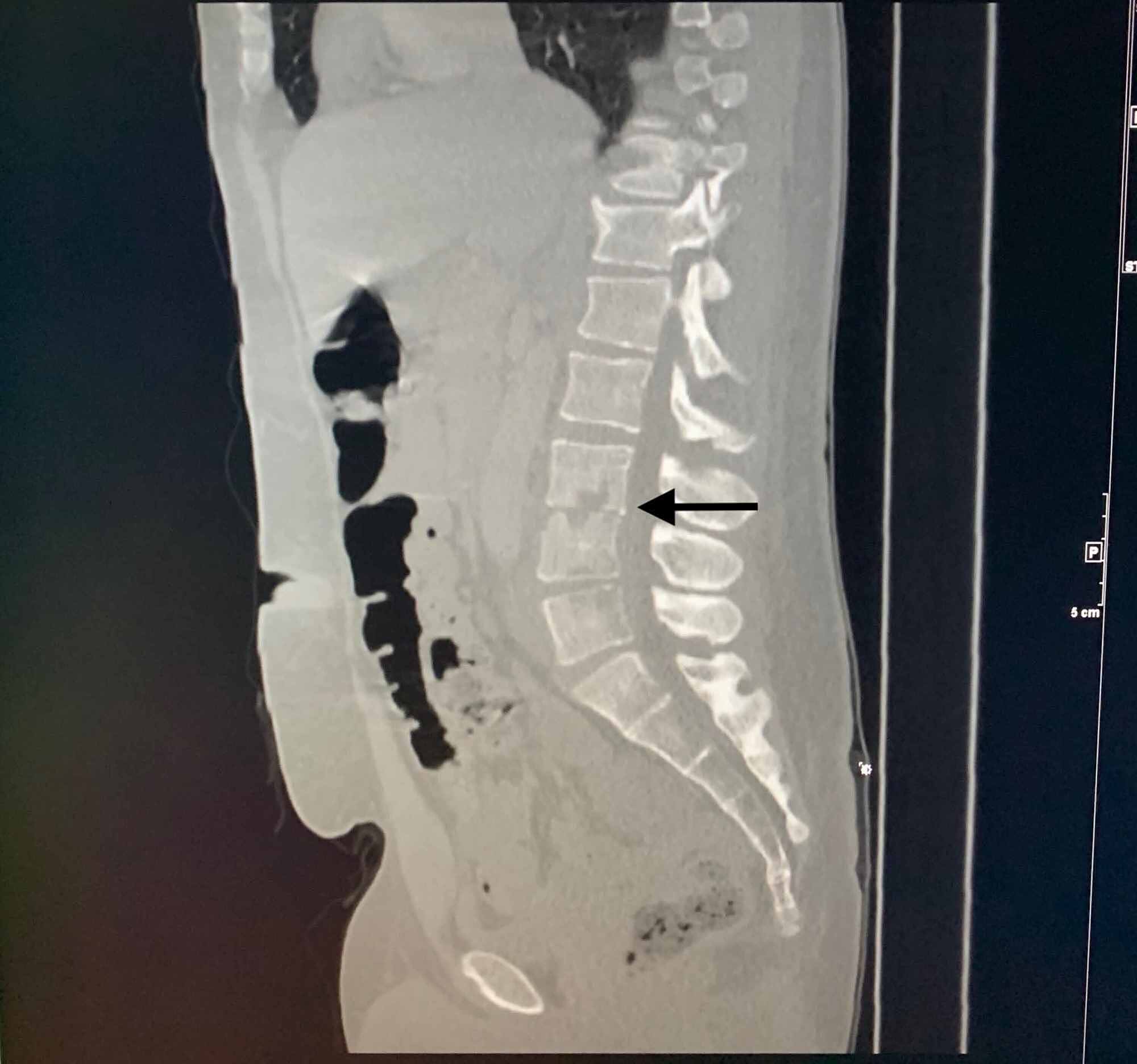 Cureus Lactobacillus Discitis Osteomyelitis In An Intravenous Drug Abuser Cureus Lactobacillus Discitis Osteomyelitis In An Intravenous Drug Abuser