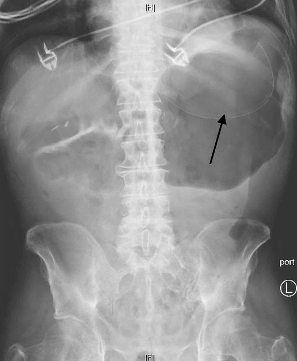 Cureus | A Twist in Crohn’s Disease: A Rare Case of Gastric Volvulus