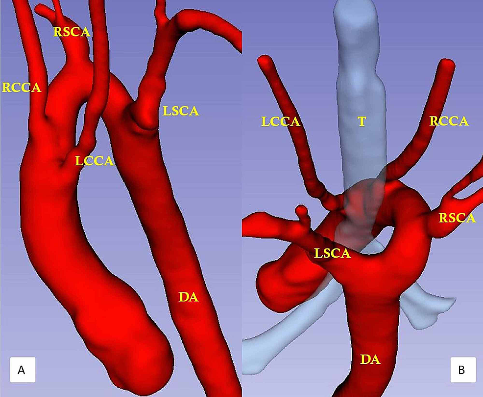 Virtual-reality-model-of-a-patient-with-a-double-arch-and-atresia-between-the-left-common-carotid-artery-and-the-left-subclavian-artery