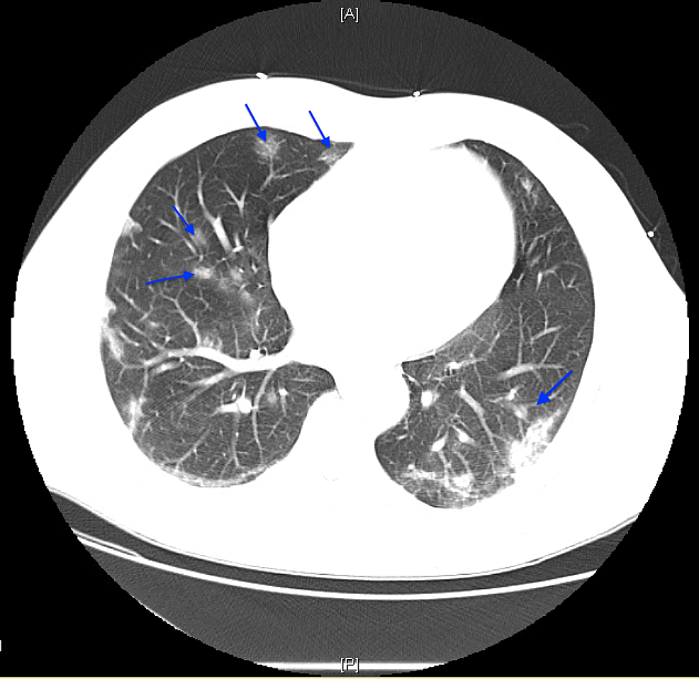 Non-contrast-chest-CT-demonstrating-patchy-subpleural-multifocal-ground-glass-opacities-involving-the-bilateral-upper-and-lower-lobes-(blue-arrows).