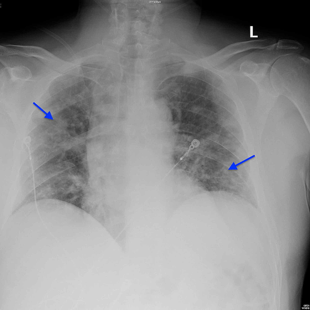 Chest-radiographs-demonstrating-bilateral-infiltrates-(arrows).
