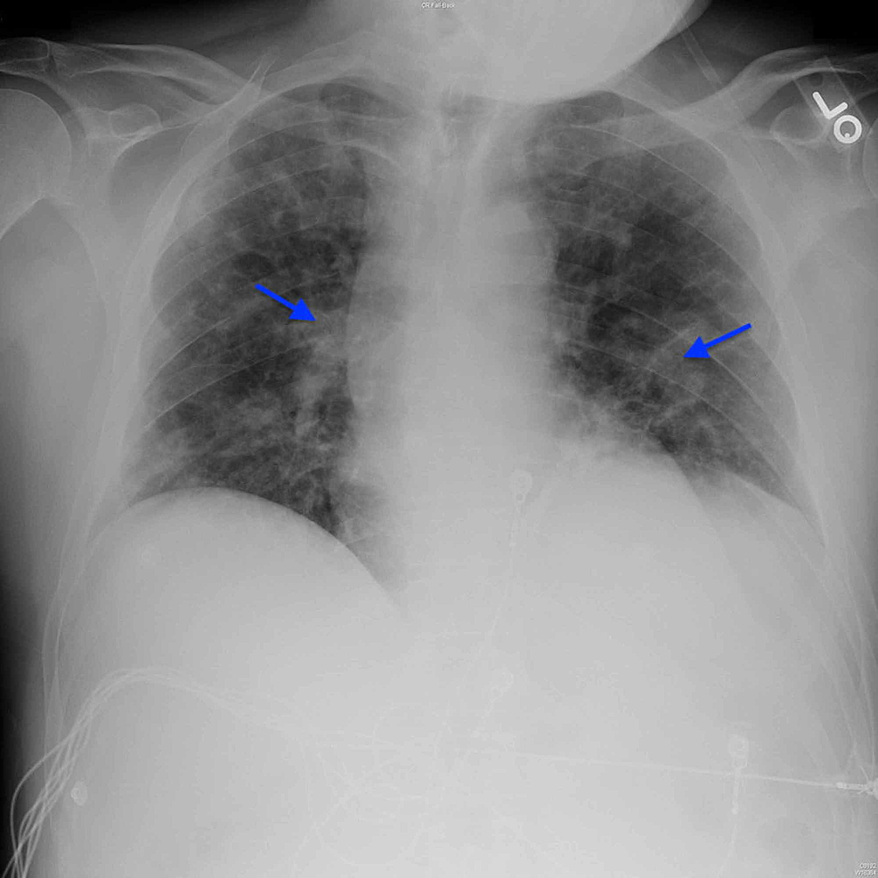 Chest-radiograph-on-day-12-demonstrating-stable-patchy-bilateral-airspace-opacities-with-superimposed-interstitial-thickening-(arrows).-Cardiomediastinal-silhouette-and-osseous-structures-are-unremarkable.