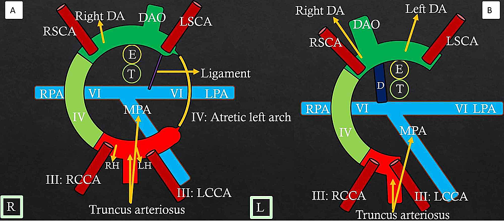 Double-arch-with-atresia-between-the-LCCA-and-LSCA---mimics-right-arch-with-the-aberrant-left-subclavian-artery