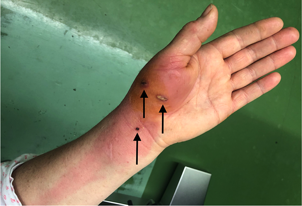 Rapidly Progressive Infection of Hand After a Cat Bite