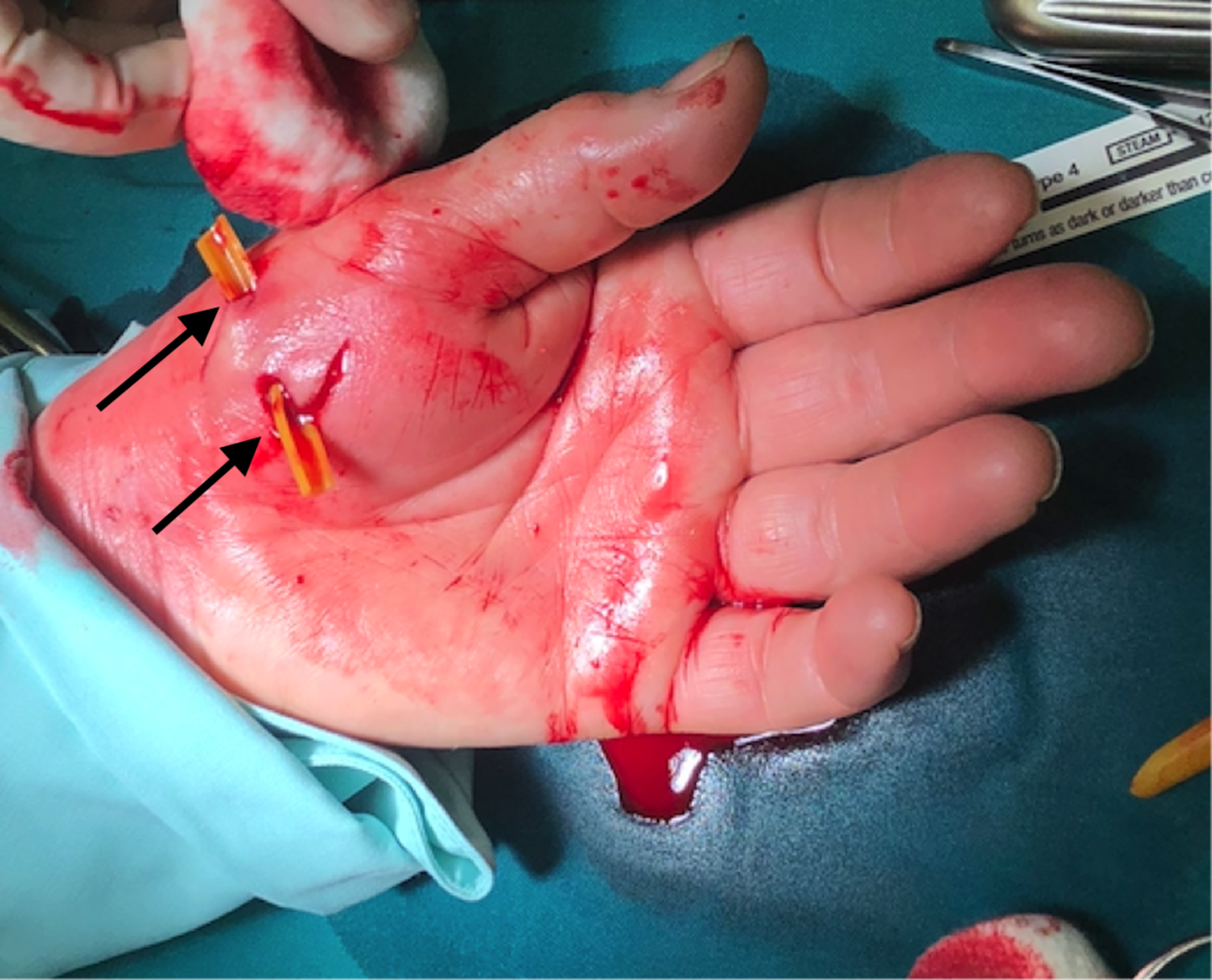 Cureus | Rapidly Progressive Infection of Hand After a Cat Bite | Article