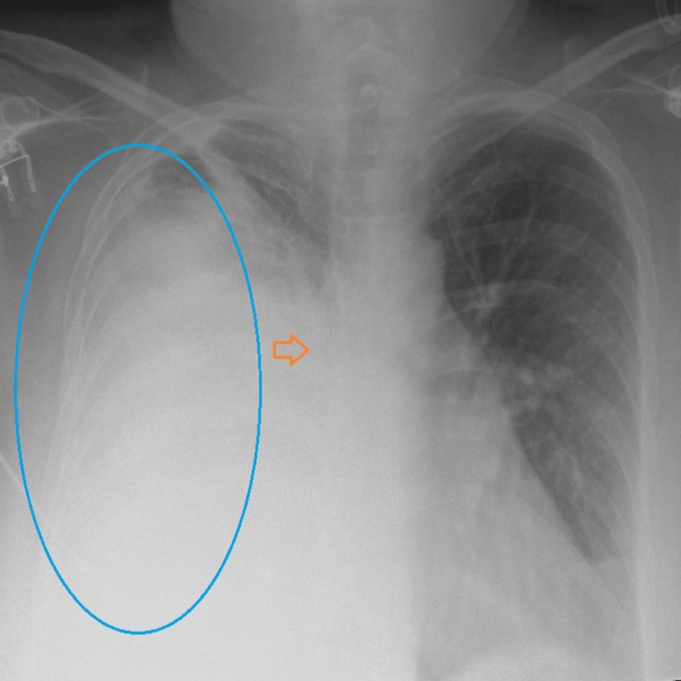 Empyema as an Unusual Presentation of Lung Cancer