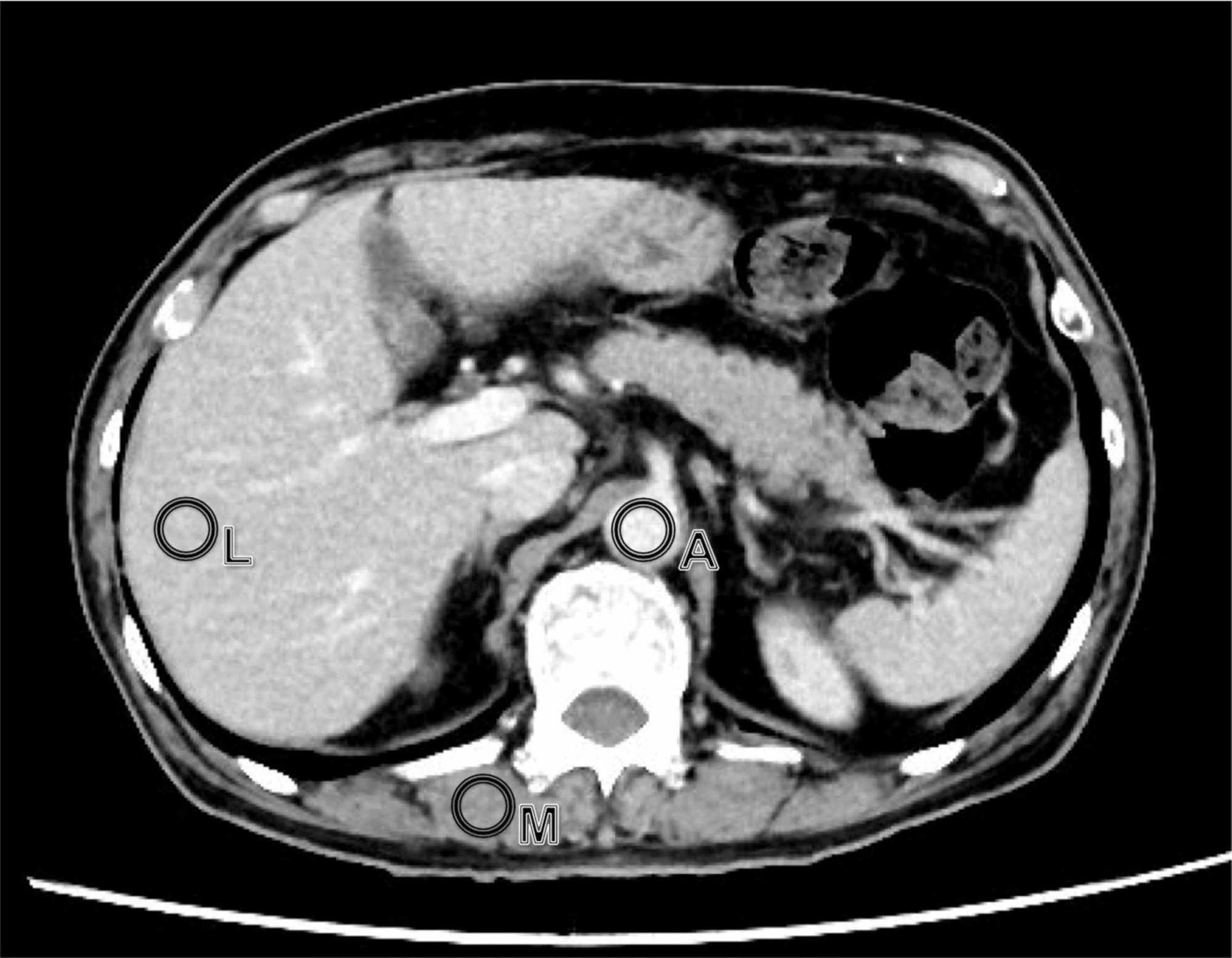 Cureus Double Dose Reduction In The Equilibrium Phase Of Chest Pelvic Ct With Low Tube Voltage 