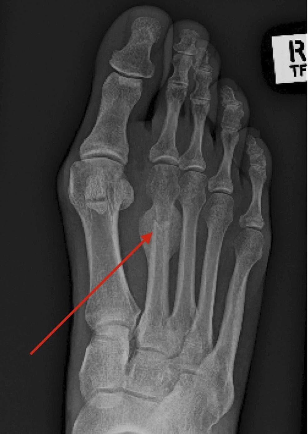 metatarsal stress fracture