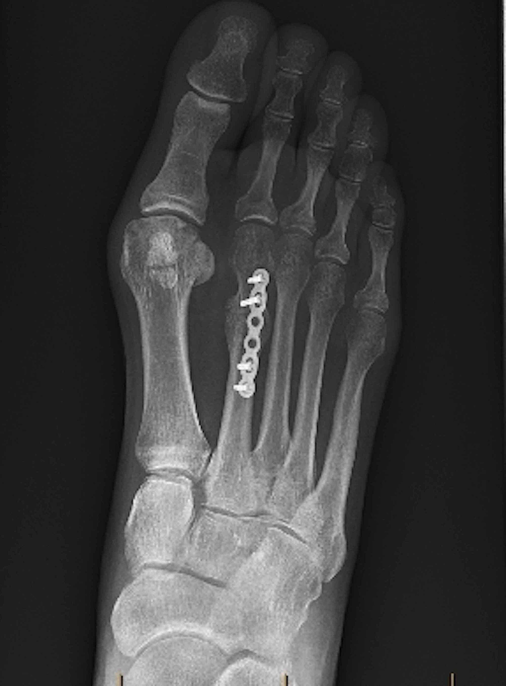 Cureus Surgical Realignment Of A Dorsiflexed Metatarsal Fracture