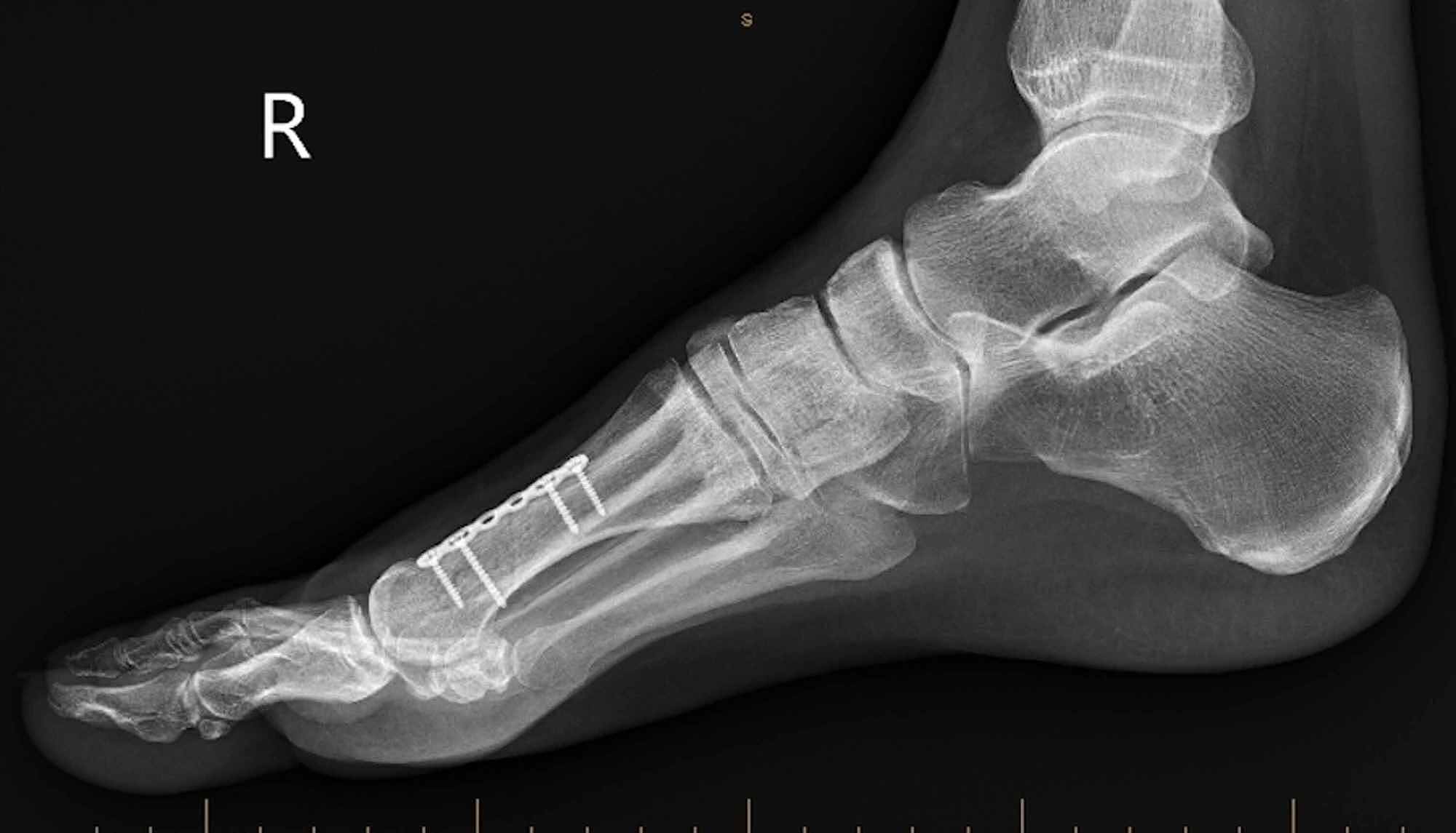 Cureus Surgical Realignment Of A Dorsiflexed Metatarsal Fracture 9734