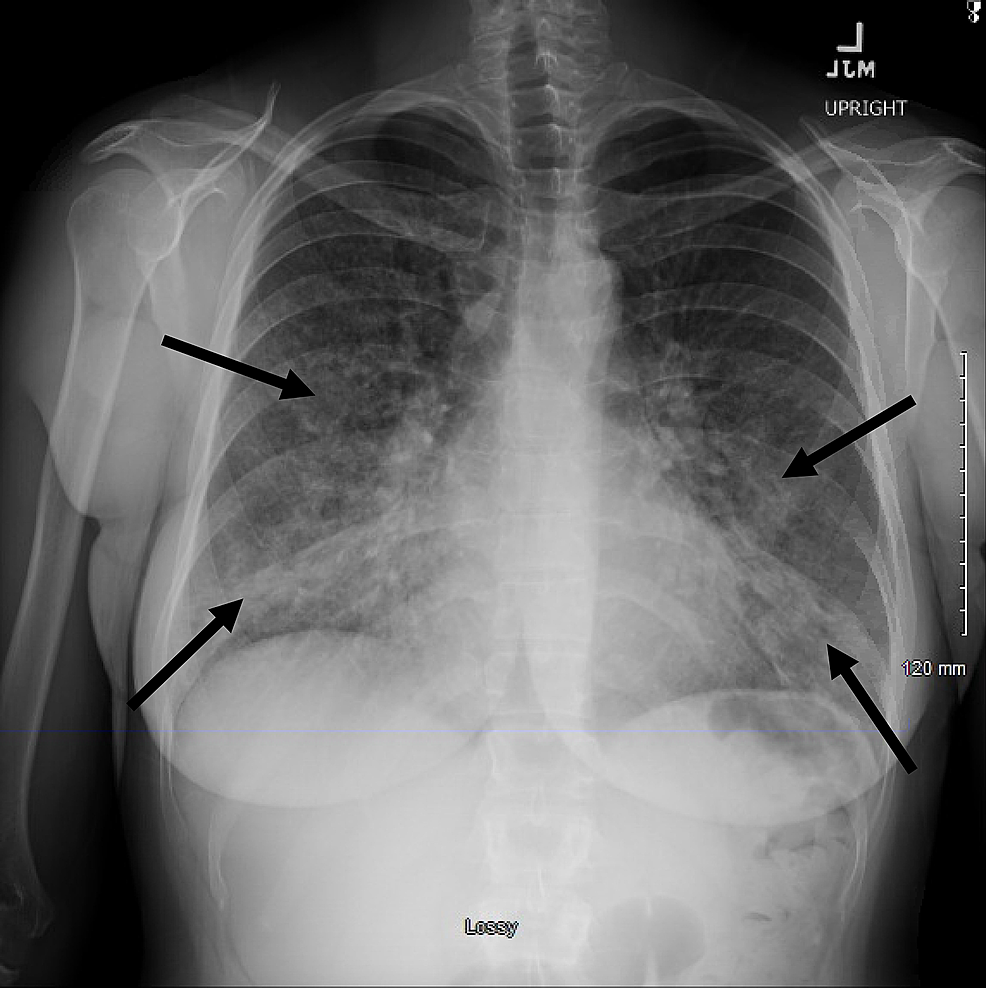 A Case for Biopsy Injectable NaltrexoneInduced Acute Eosinophilic