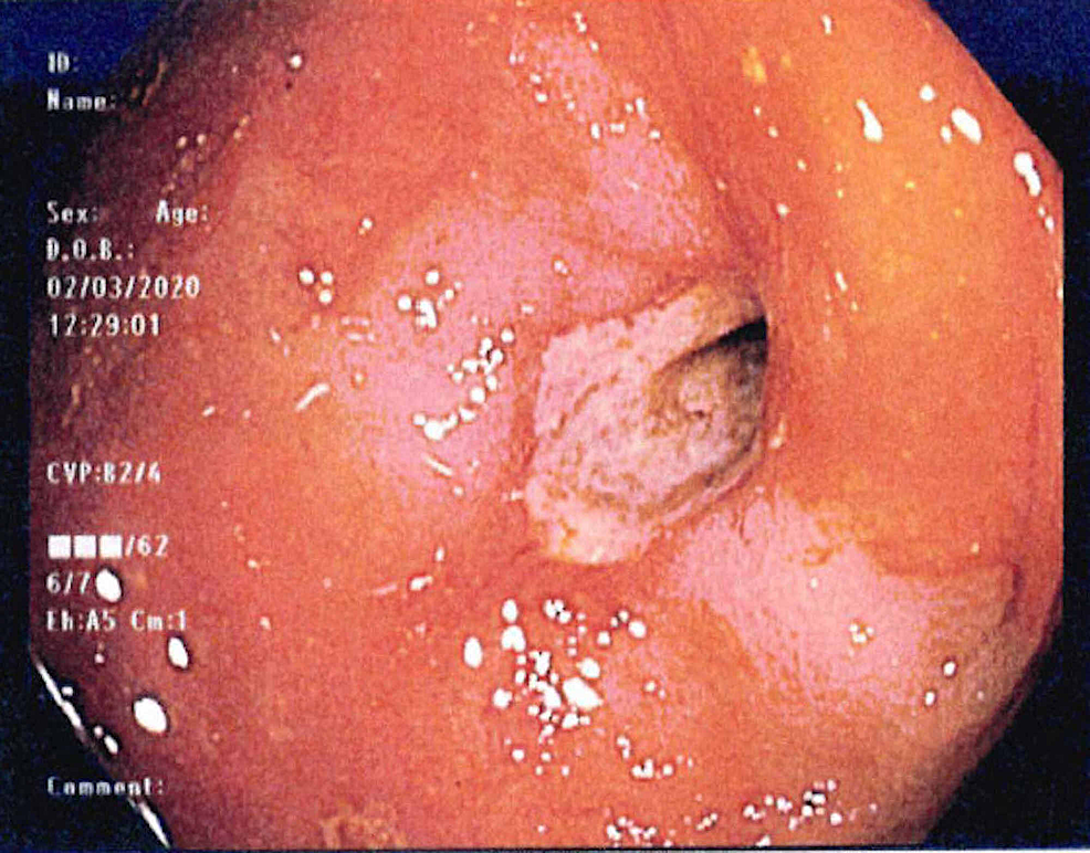 Colonoscopic-view-demonstrating-a-90%-obstructed-lumen-in-the-hepatic-flexure-of-the-colon.