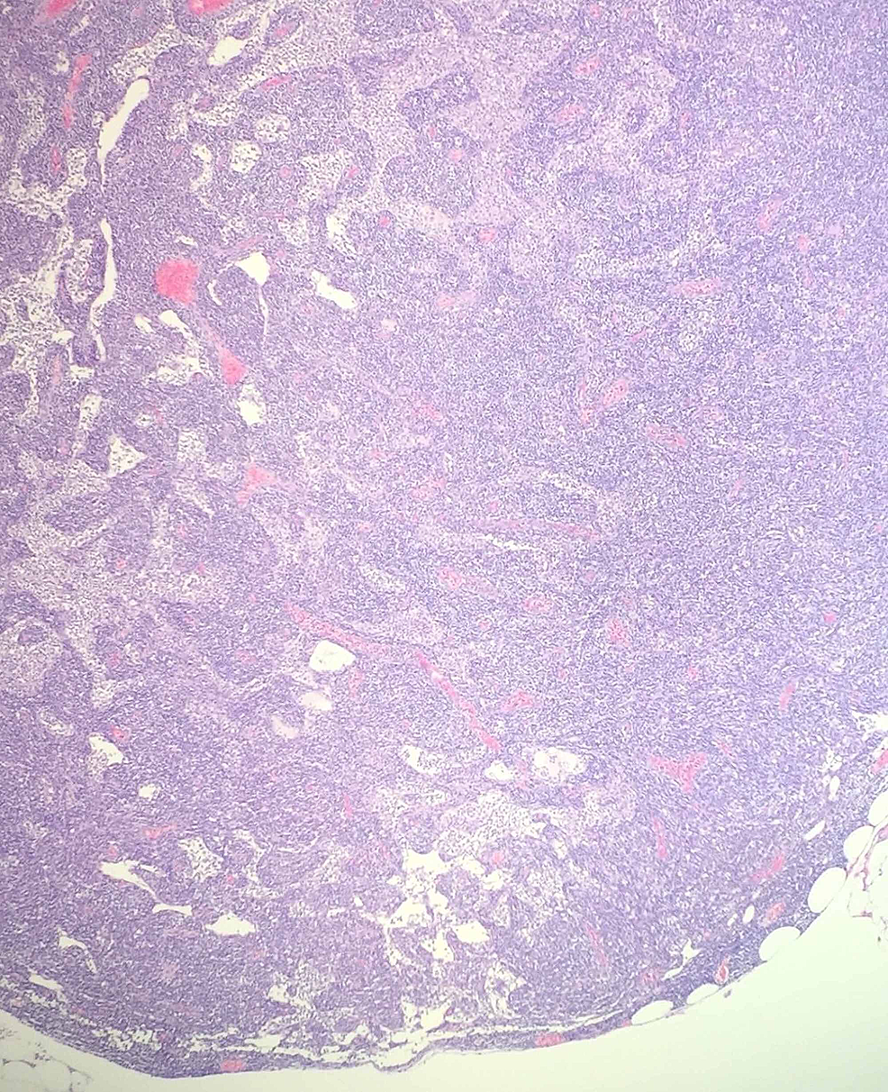 Pericolic-lymph-node-with-effaced-architecture-(no-follicles-with-germinal-centers-are-present),-hematoxylin-and-eosin-stain.-Magnification-of-×100.-