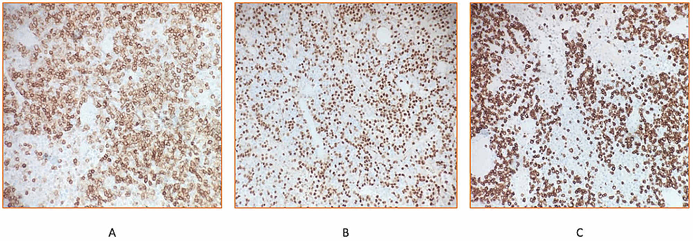 Immunohistochemical-staining:-CD5-membranous-stain-highlights-atypical-B-lymphocytes-(A)-that-also-stains-positive-with-PAX5-(nuclear-stain,-B)-and-negative-for-CD3-(CD3-highlights-background-T-cells)-(C).-All-images-have-magnification-of-×200.