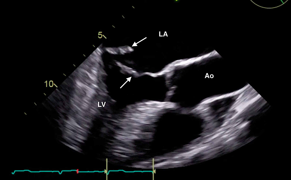 Transesophageal-echocardiogram-demonstrating-normal-position-of-the-anterior-mitral-leaflet-(rightward-pointing-arrow)-and-flail-motion-of-the-posterior-mitral-leaflet-(leftward-pointing-arrow).-