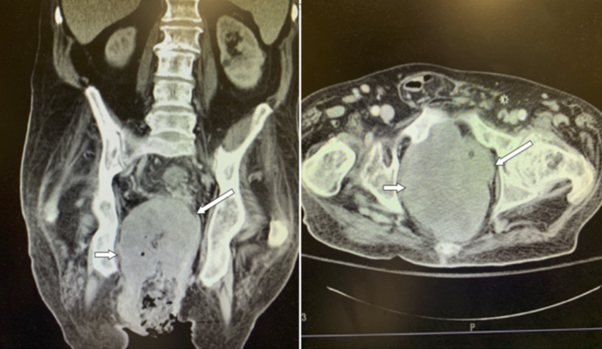 Cureus Fournier’s Gangrene in the Setting of Underlying Carcinoma A
