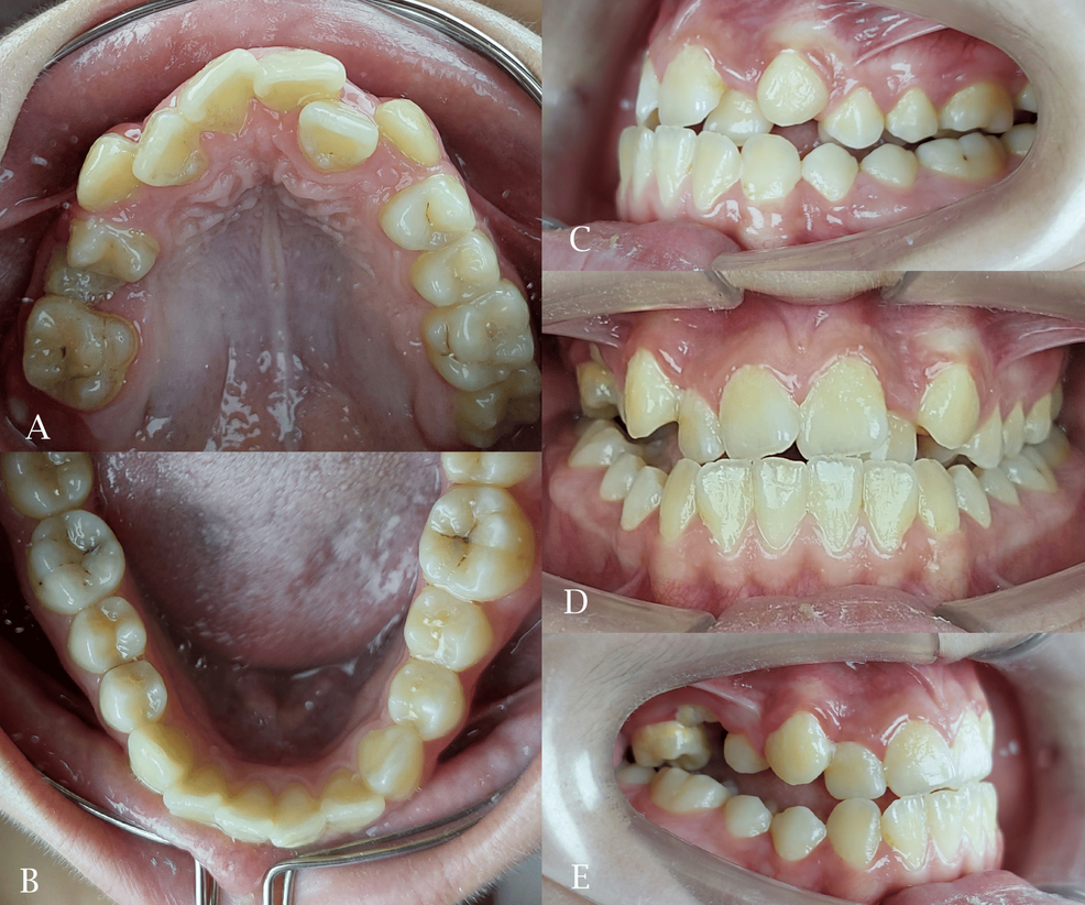 Non-surgical Treatment of Severe Skeletal Class III Malocclusion