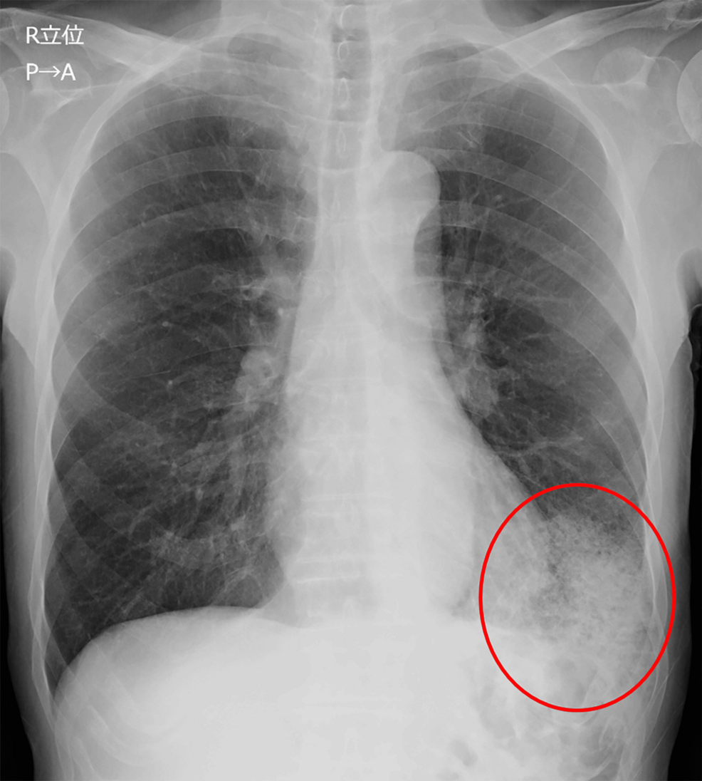 Legionnaires' Disease and Hippocampal Sclerosis: A Case Report - News Directory 3