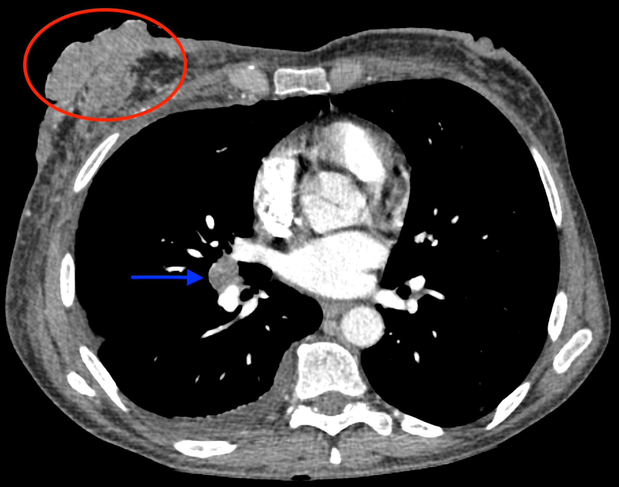 Cureus A Case of Asymmetric Nipple Enhancement as an Imaging