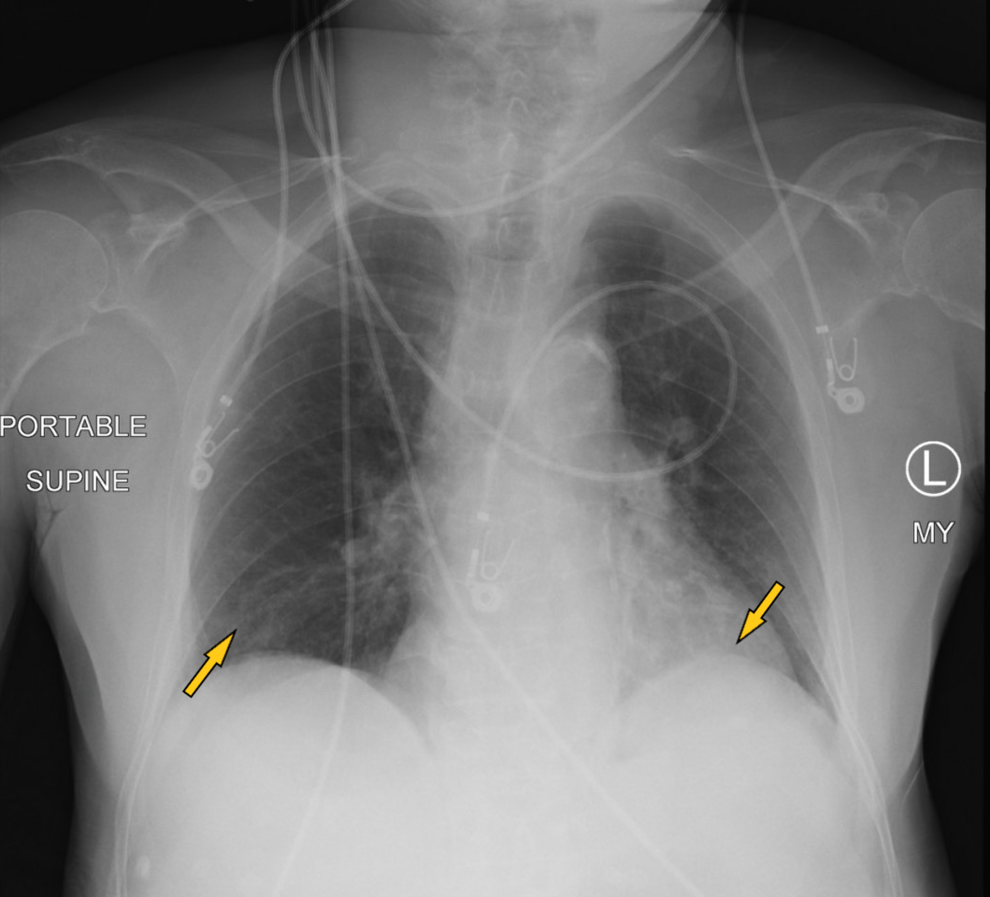 Cureus | Seizures Related to Coronavirus Disease (COVID-19): Case