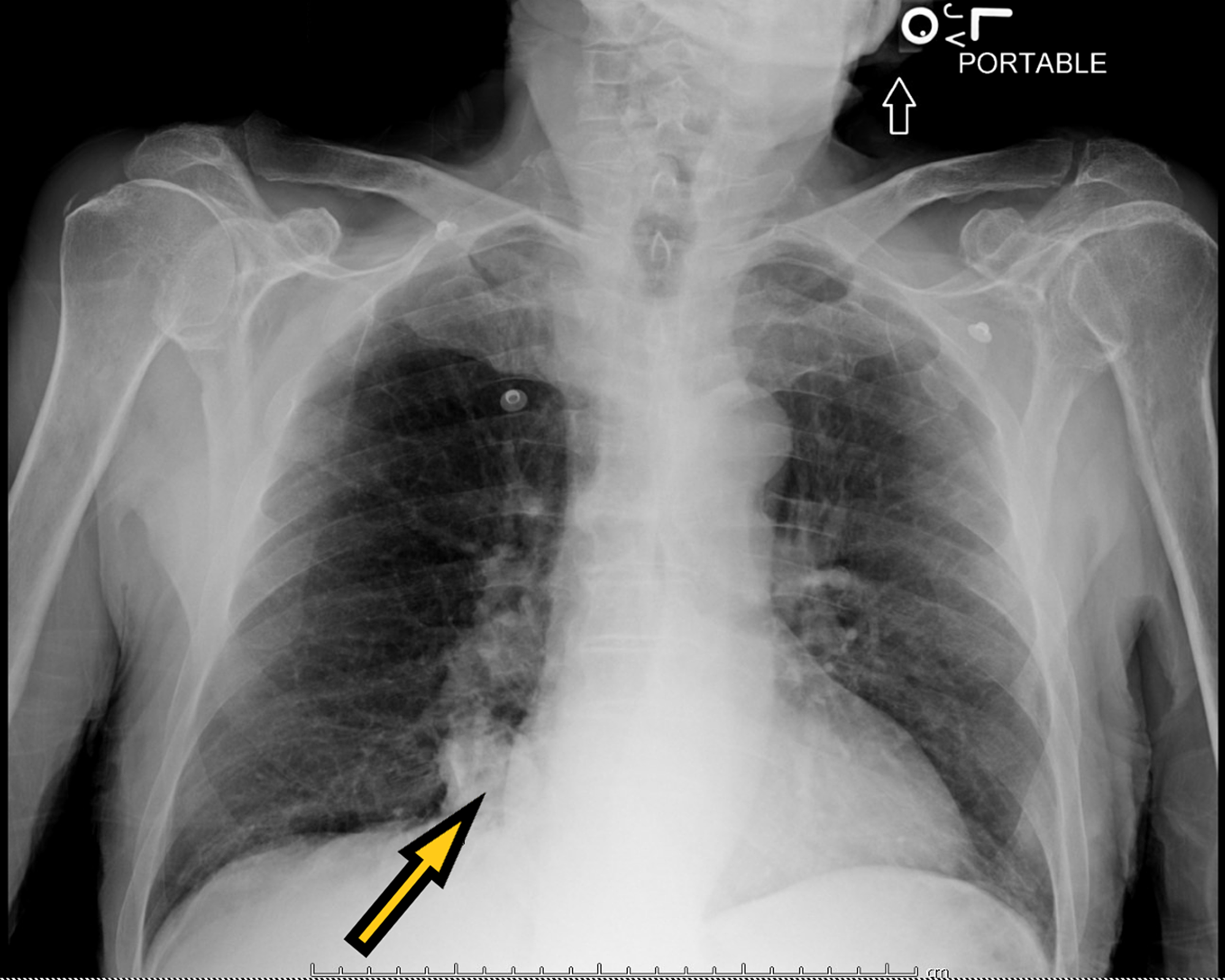 Chest x ray interpretation of findings picture