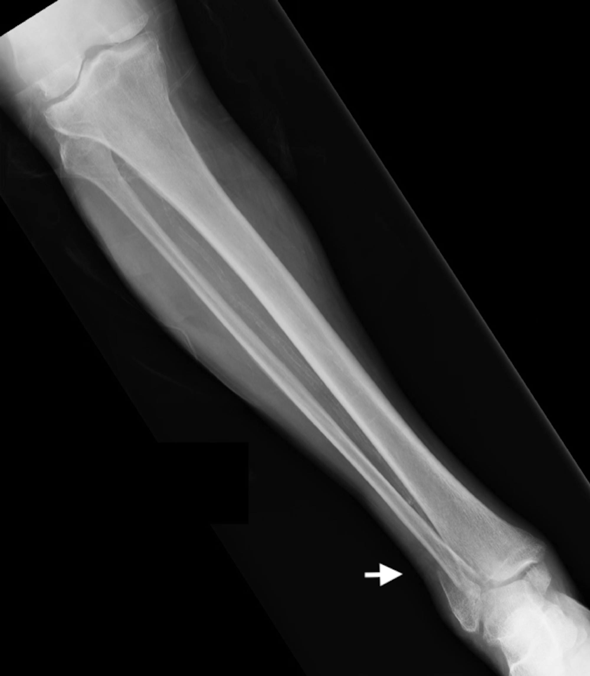 hairline fracture in shin