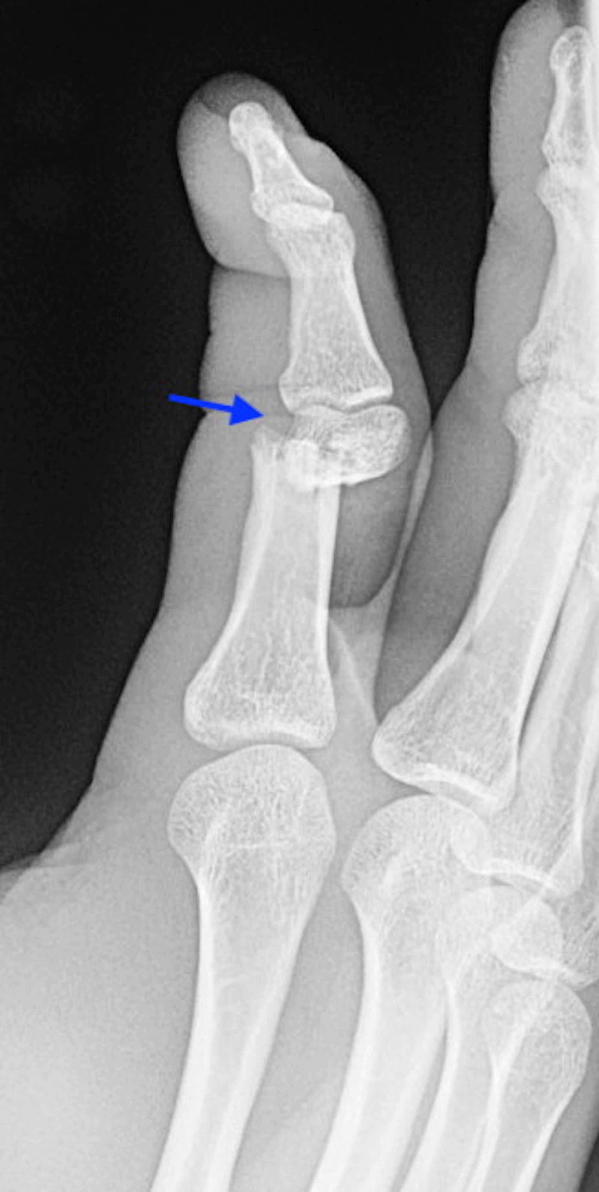 Cureus Phalangeal Fracture Secondary to Hammering One’s Finger