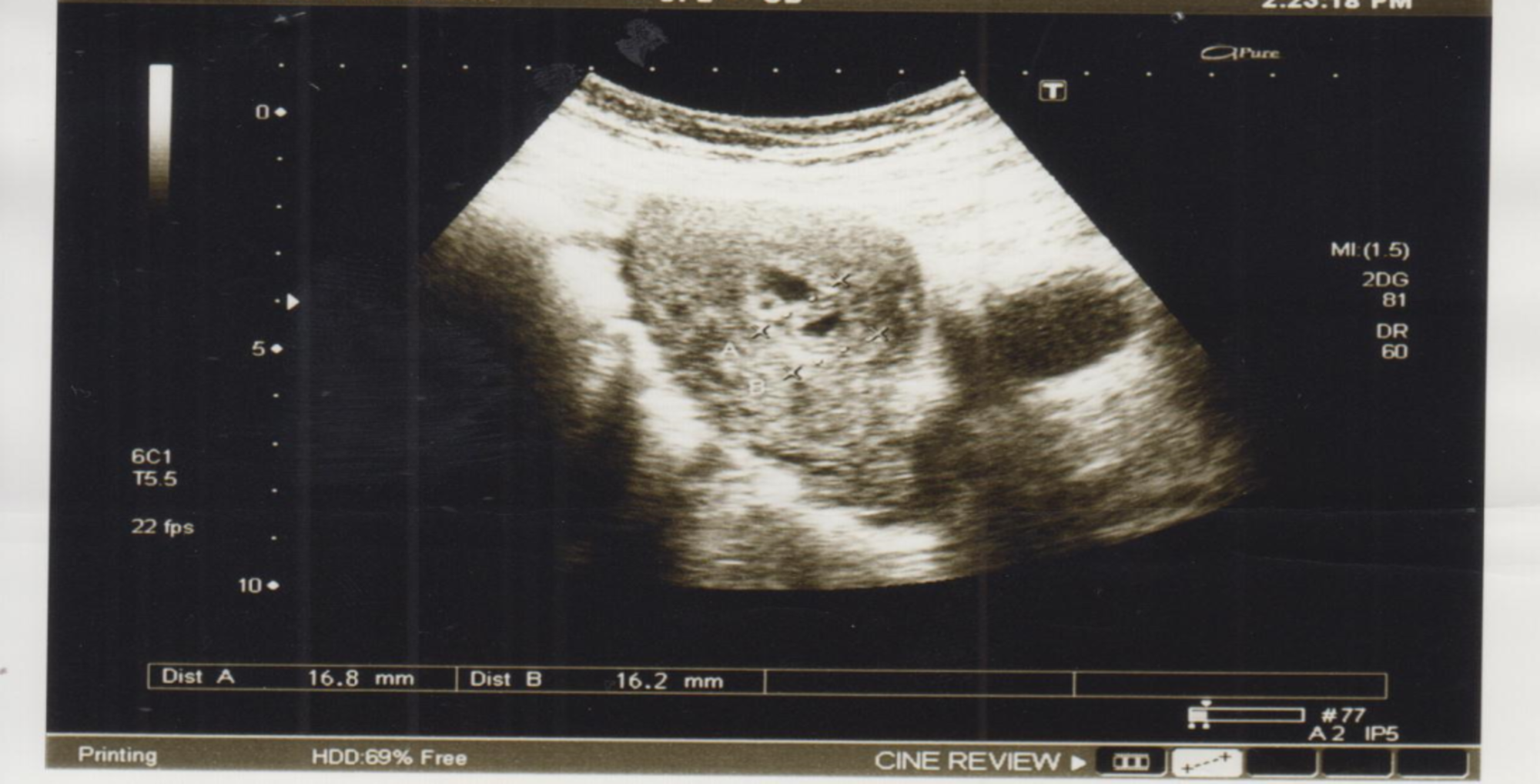 Cureus A Case Series on Uterine Arteriovenous Malformations A LifeThreatening Emergency in