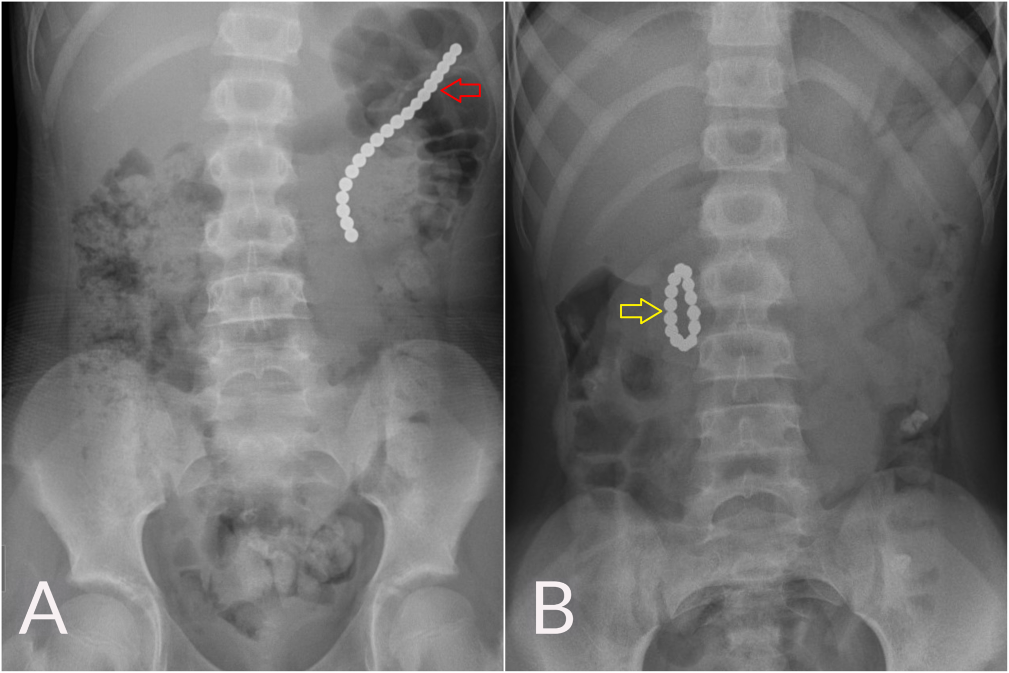 Cureus A Child With a Gastrocolic Fistula After Ingesting An