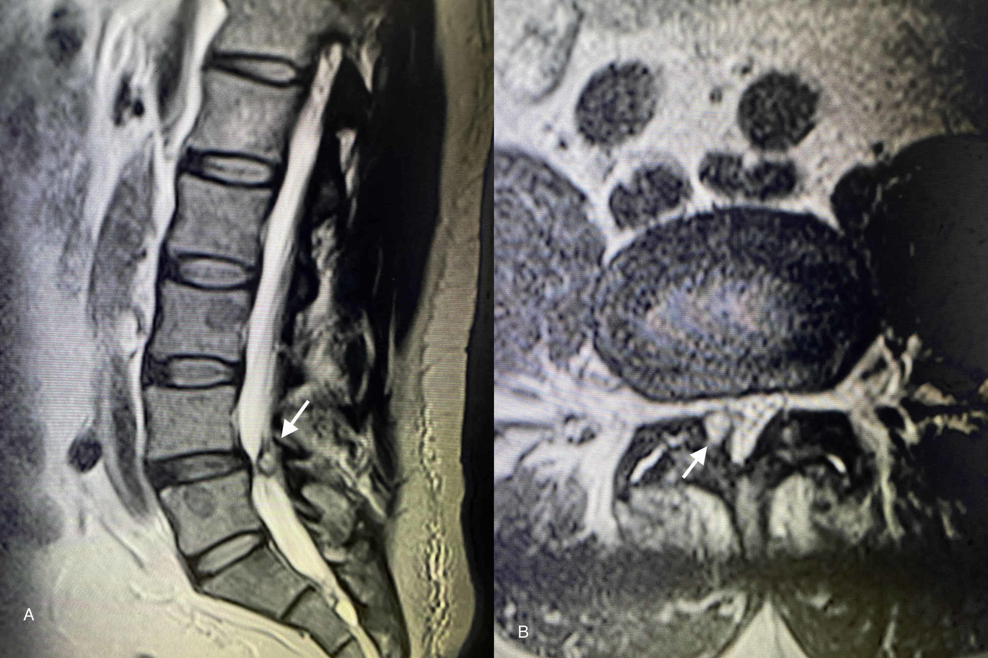 Cureus Lumbar Facet Joint Cyst Treated With and