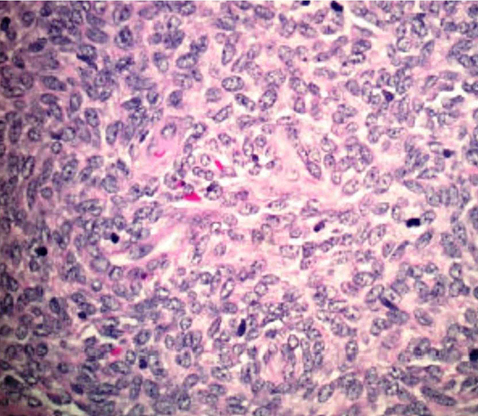 Cureus Recurrence of Endometrial Stromal Two Decades Post
