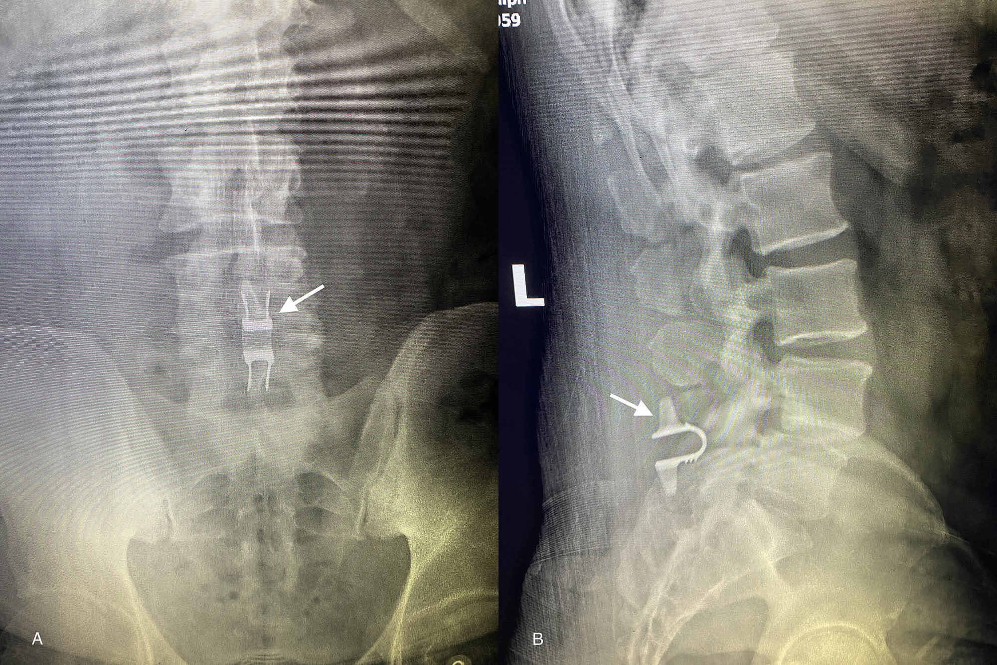Cureus Lumbar Facet Joint Cyst Treated With Decompression And Interlaminar Stabilization