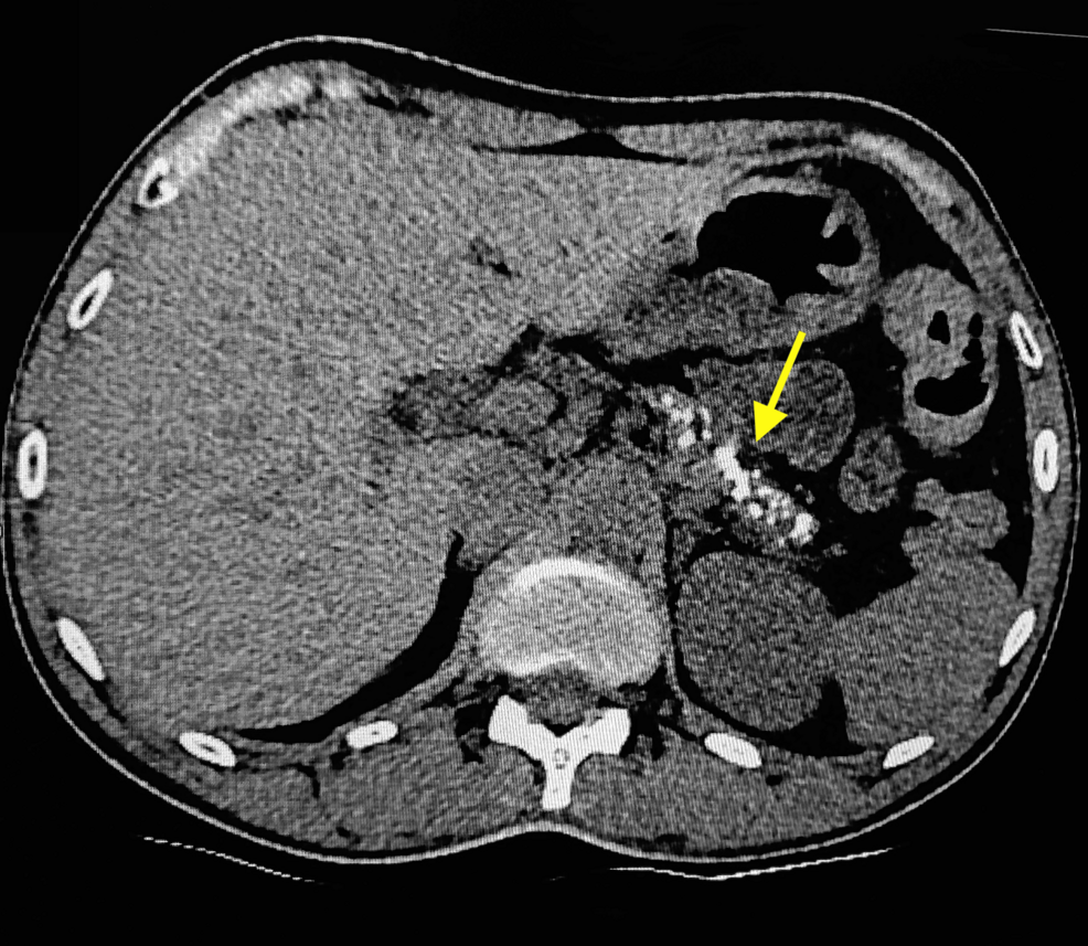 Pancreatogenic Type 20c Diabetes Revealed by Diabetic ...