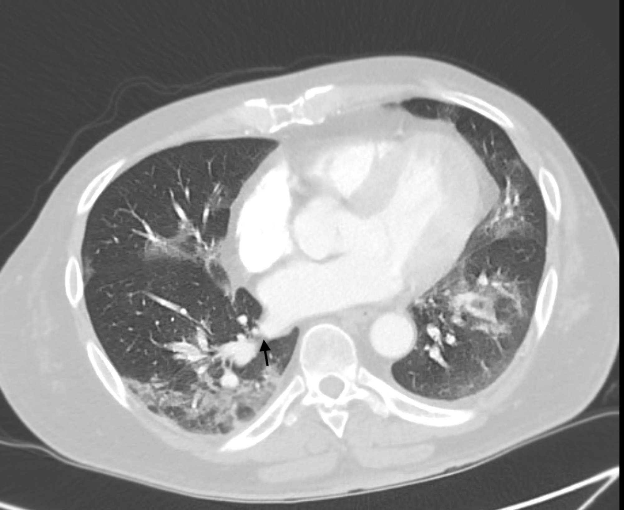 Cureus Acute Pulmonary Embolism In Covid A Report Of Two Cases
