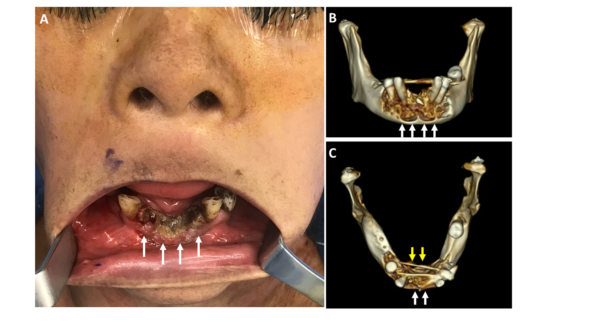 Virtual Surgical Planning For Bisphosphonate Related Osteonecrosis Of The Jaw A Valuable Application In Advanced Cases Cureus