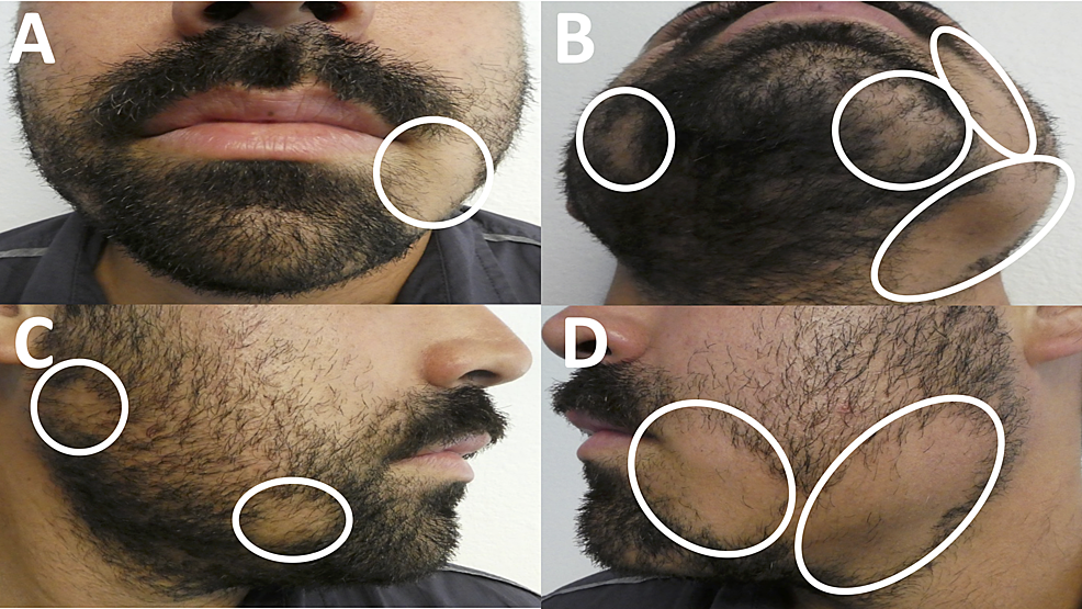 Incipient Diabetes Mellitus and Nascent Thyroid Disease Presenting as Beard Alopecia Areata: Case Report and Treatment Review of Alopecia Areata of the Beard