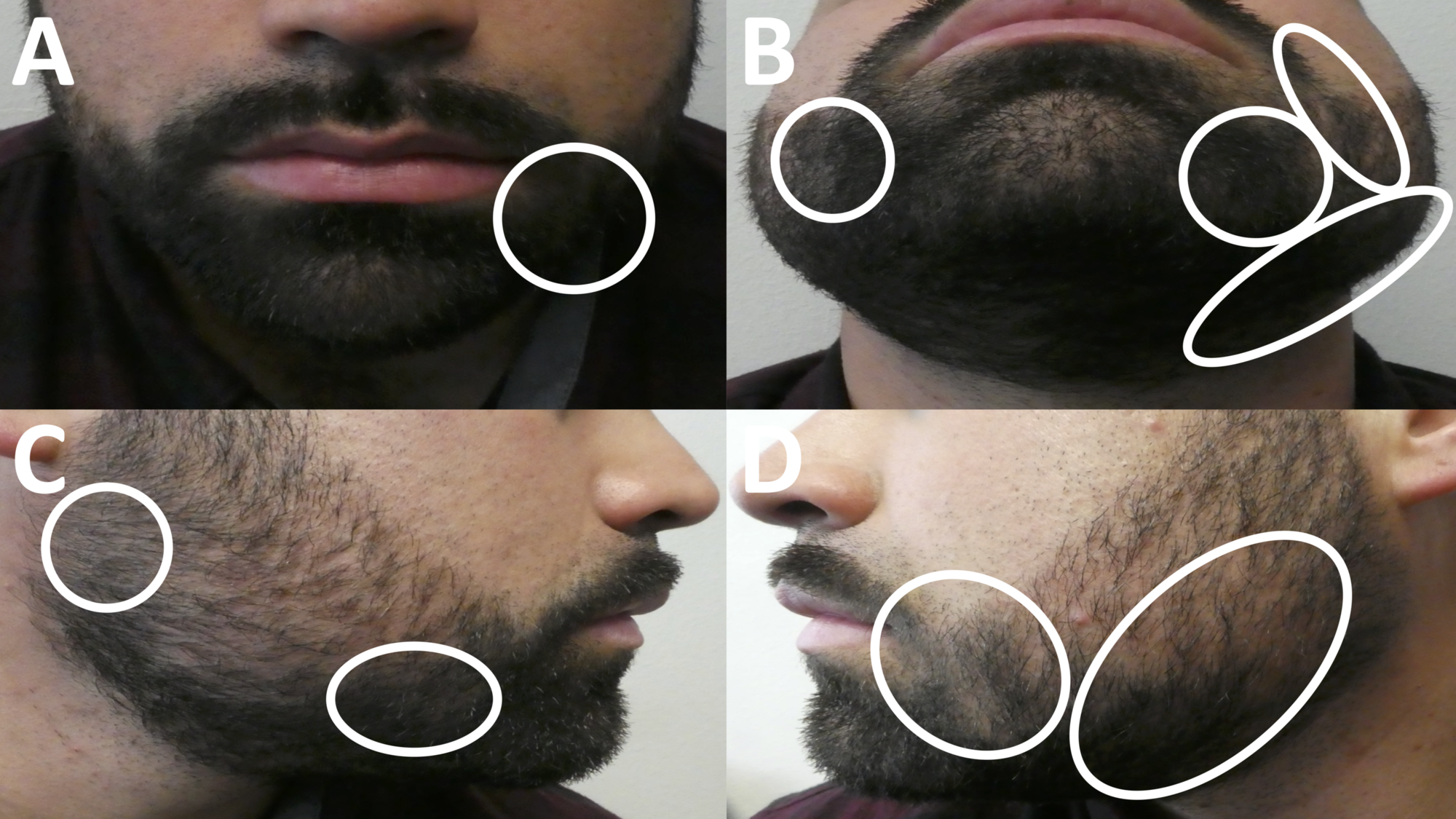 Cureus | Incipient Diabetes Mellitus and Nascent Thyroid Disease Presenting  as Beard Alopecia Areata: Case Report and Treatment Review of Alopecia  Areata of the Beard | Article