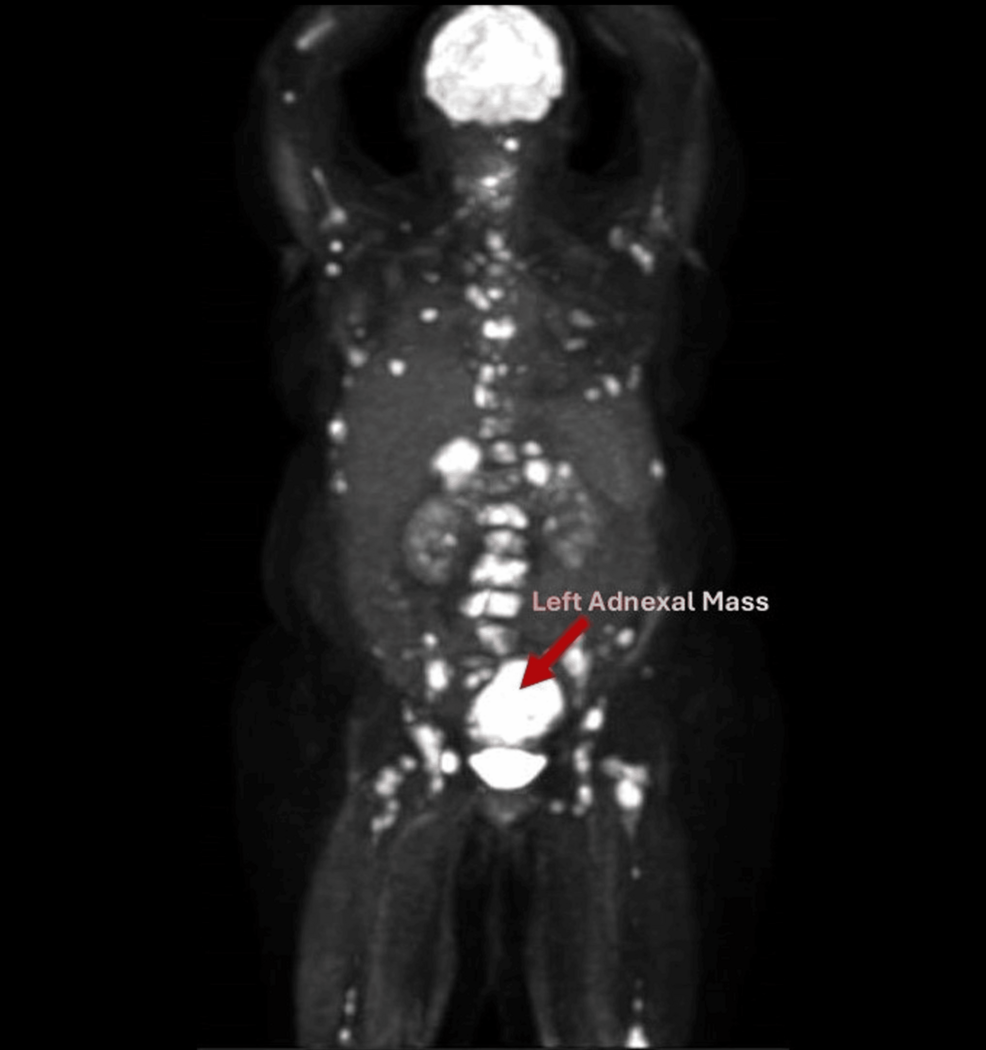 metastatic melanotic sarcoma Eye neoplasm Metastatic melanoma and rare melanoma