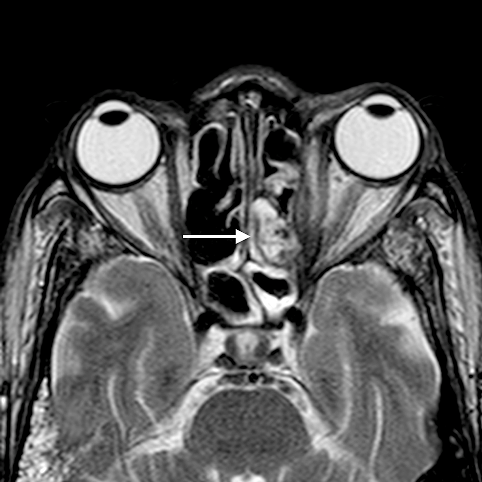 Orbital-cellulitis:-axial-T2WI-shows-abnormal-soft-tissue-in-the-left-posterior-ethmoid-air-cells-(arrow)-appearing-hyperintense