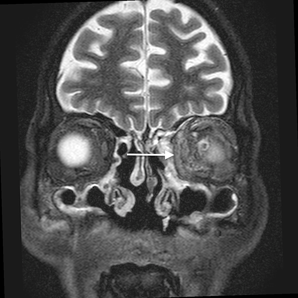 Orbital-cellulitis:-coronal-STIR-image-shows-hyperintense-soft-tissue-(arrow)-extending-into-the-extraconal-compartment-of-the-left-orbit,-abutting-the-medial-rectus-with-surrounding-fat-stranding