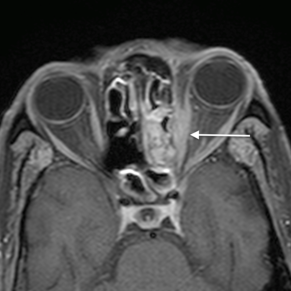 Orbital-cellulitis:-axial-post-contrast-T1WI-shows-enhancement-of-the-abnormal-soft-tissue-(arrow)